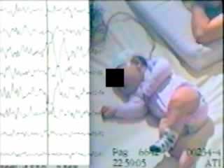 Epileptic spasms in clusters without hypsarrhythmia in infancy