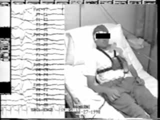 Paroxysmal autonomic alterations mimicking epilepsy: a case report