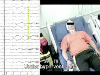 Spinal algetic-tonic seizures manifesting as paroxysmal «positive» Brown-Séquard syndrome