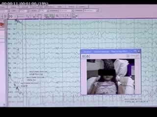 Ictal hiccup during absence seizure in a child