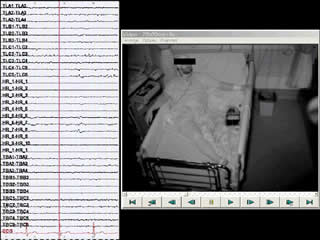 Mirthful gelastic seizures with ictal involvement of temporobasal regions