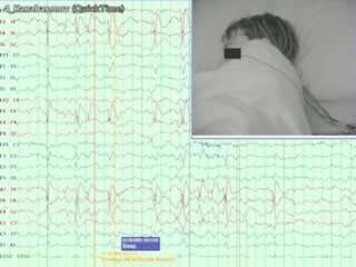 Seizure in benign epilepsy with centro-temporal spikes