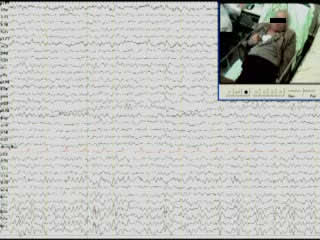 Epilepsia partialis continua as the presenting symptom in probable sporadic Creutzfeldt-Jakob disease