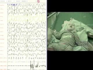 Angelman syndrome and pseudo-hypsarrhythmia: a diagnostic pitfall