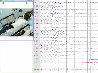 Recurrence of childhood absence epilepsy as pyknolepsy in adolescence