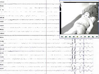 Epileptic diaphragm myoclonus