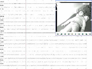 Epileptic diaphragm myoclonus