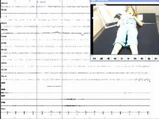 Epileptic diaphragm myoclonus