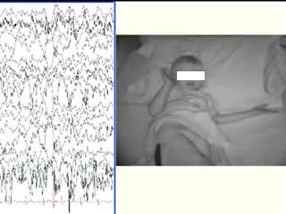Video-EEG documented lengthy seizure in Panayiotopoulos syndrome: clinical manifestations may be inconspicuous
