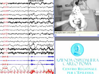 Head atonic attacks: a new type of benign non-epileptic attack in infancy strongly mimicking epilepsy