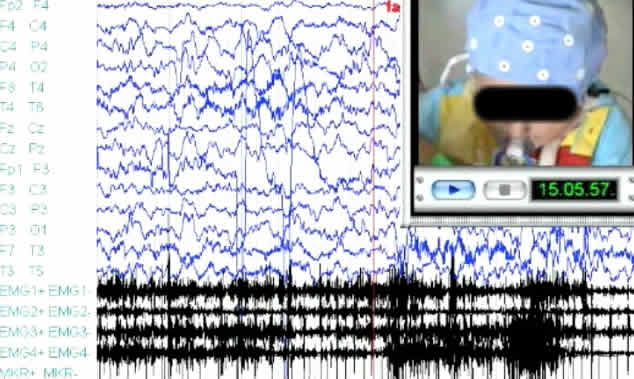 Head atonic attacks: a new type of benign non-epileptic attack in infancy strongly mimicking epilepsy