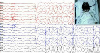 Gastaut type idiopathic childhood occipital epilepsy