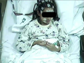 Gastaut type idiopathic childhood occipital epilepsy