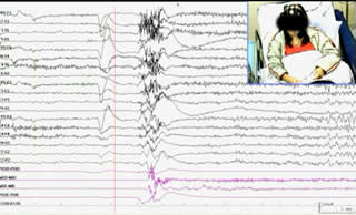 Corpus callosotomy in a patient with startle epilepsy