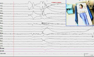 Corpus callosotomy in a patient with startle epilepsy