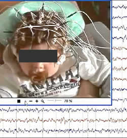 Early-onset absence epilepsy aggravated by valproic acid: a video-EEG report