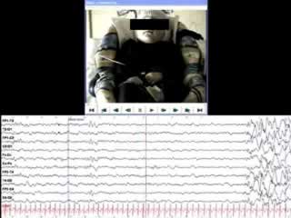 A simple febrile seizure with focal onset