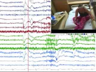 Severe cardioinhibitory vasovagal syncope in sleep and supine posture