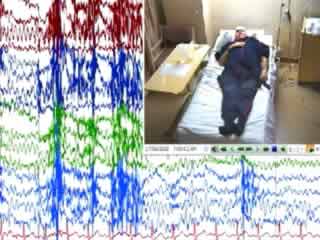 Severe cardioinhibitory vasovagal syncope in sleep and supine posture