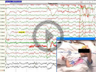 Peri-ictal headache due to epileptiform activity in a disconnected hemisphere