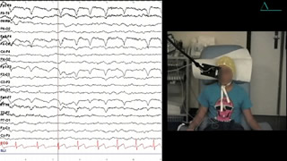 A child with ictal vocalizations and generalized epilepsy