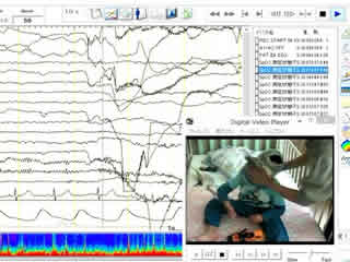 Generalized seizure with falling and unresponsive staring provoked by somatosensory stimulation: a video-EEG study
