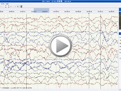 Ictus emeticus presenting as an unusual seizure type in chromosome 22q11.2 deletion syndrome