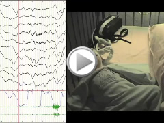 Epileptic spasms in congenital disorders of glycosylation