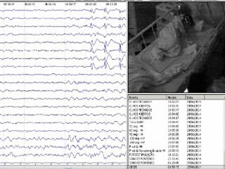 The semiology of benign focal epilepsy with affective symptoms