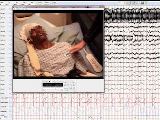 Ictal laryngospasm monitored by video-EEG and polygraphy: a potential SUDEP mechanism