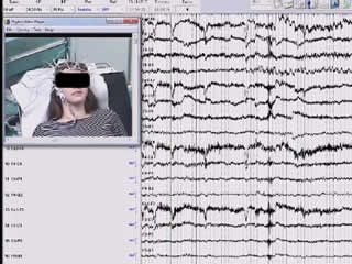 Epileptic ictal strabismus: a case report and review of the literature