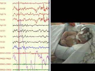 Neonatal tremor episodes and hyperekplexia-like presentation at onset in a child with SCN8A developmental and epileptic encephalopathy