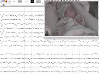 Electroclinical history of a five-year-old girl with GRIN1-related early-onset epileptic encephalopathy: a video-case study