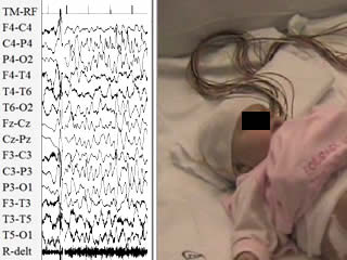 Diaper changing-induced reflex seizures in CDKL5-related epilepsy