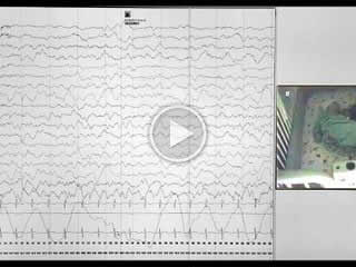 Intractable apnoeic seizures in a child with a deletion typically associated with Williams syndrome