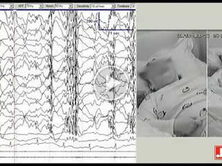 The electroclinical features of idiopathic generalized epilepsy patients presenting with fixation-off sensitivity