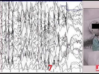 The electroclinical features of idiopathic generalized epilepsy patients presenting with fixation-off sensitivity