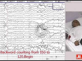 The electroclinical features of idiopathic generalized epilepsy patients presenting with fixation-off sensitivity