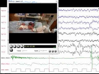 A novel mutation in KCNQ3-related benign familial neonatal epilepsy: electroclinical features and neurodevelopmental outcome