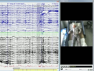 Ictal kissing in a patient with right frontal lobe epilepsy