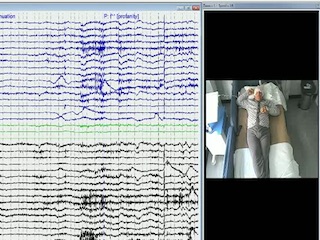 Ictal kissing in a patient with right frontal lobe epilepsy