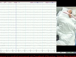 Facial dystonic seizures-plus associated with anti-LGI1 antibody encephalitis