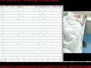 Facial dystonic seizures-plus associated with anti-LGI1 antibody encephalitis