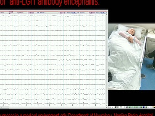 Facial dystonic seizures-plus associated with anti-LGI1 antibody encephalitis