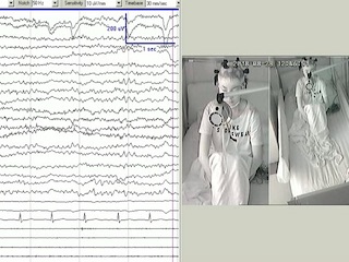 Intermittent photic stimulation-provoked seizure associated with ictal asystole