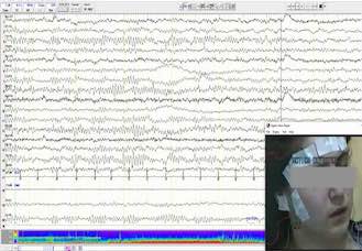 Pitfalls in the diagnosis of Jeavons syndrome: a study of 32 cases and review of the literature