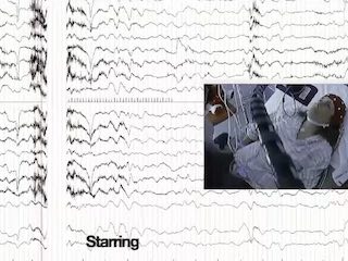 Video-EEG illustration of transient episodes of loss of consciousness correlating with plateau-waves due to intracranial hypertension