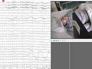 EEG source estimation in a rare patient with cold-induced reflex epilepsy