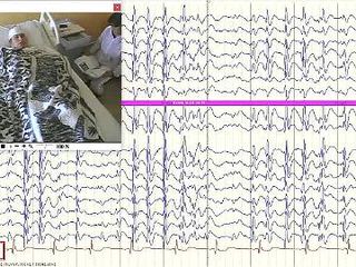 Post-ictal whistling in Lennox-Gastaut syndrome