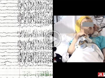 Jerking during absences: video-EEG and polygraphy of epileptic myoclonus associated with two paediatric epilepsy syndromes